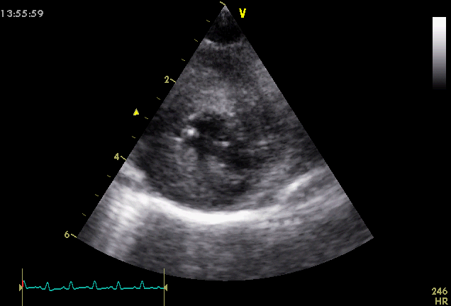 ultrasound of heart