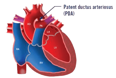 patent ductus arterious