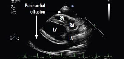 image of heart with pericardial fluid surrounding the heart